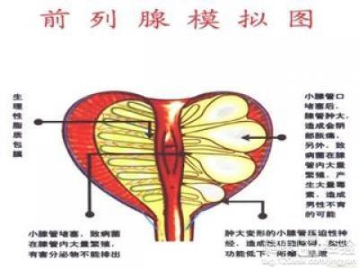 前列腺炎最新療法的研究、應用與實踐探索