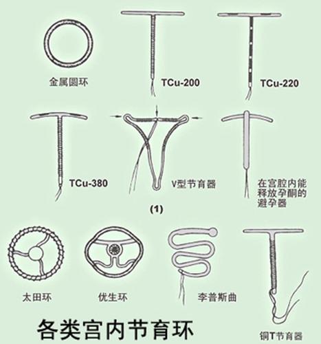 最新節育環研究進展與應用概述