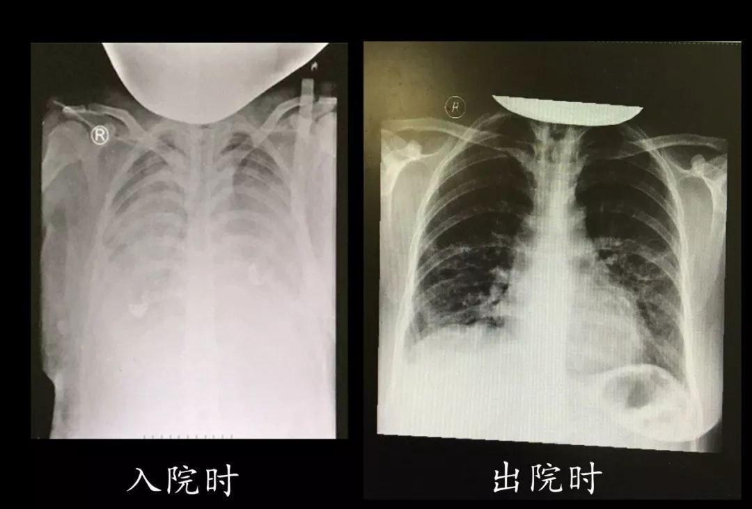 新冠肺炎最新保險,新冠肺炎最新保險，保障你我他的全面解決方案